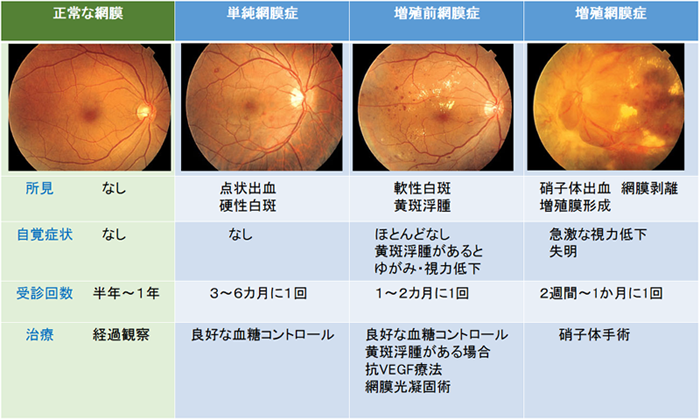 眼底検査で糖尿病網膜症を発見できますか?